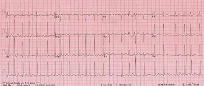 Hyperthyroidism With Atrial Fibrillation in Children: A Case Report and Review of the Literature